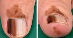 Bác sĩ chỉ ra những dấu hiệu trên móng tay có thể cảnh báo bệnh