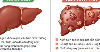 Biến đổi về màu da, nước tiểu cảnh báo ung thư gan