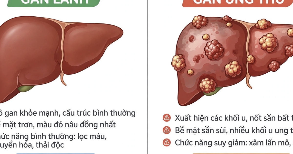 Biến đổi về màu da, nước tiểu cảnh báo ung thư gan