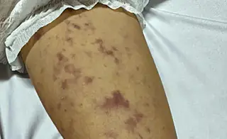 Sau chùm ca bệnh nhiễm não mô cầu tại trường học ở TP. HCM, Bộ Y tế khuyến cáo gì?