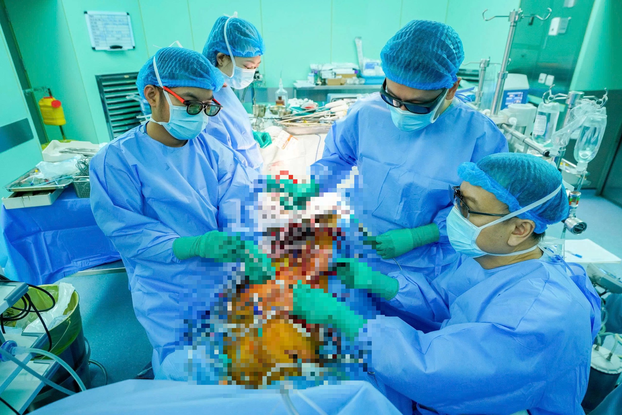 Ê kíp phối hợp thực hiện các thao tác sửa van qua đường mổ nhỏ ở ngực phải, hạn chế mở xương ức