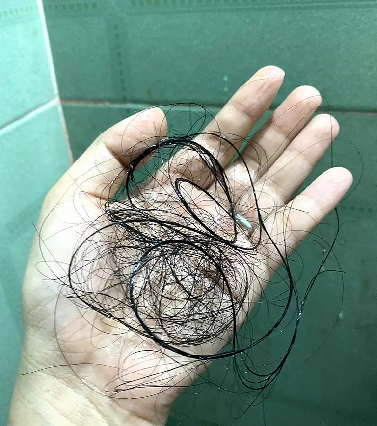 Một lượng tóc bị rụng khá nhiều trong lúc gội đầu của một bạn trẻ - Ảnh: BÌNH NGHI