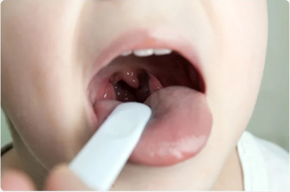 Viêm mũi họng kéo dài ảnh hưởng gì đến sức khỏe trẻ?