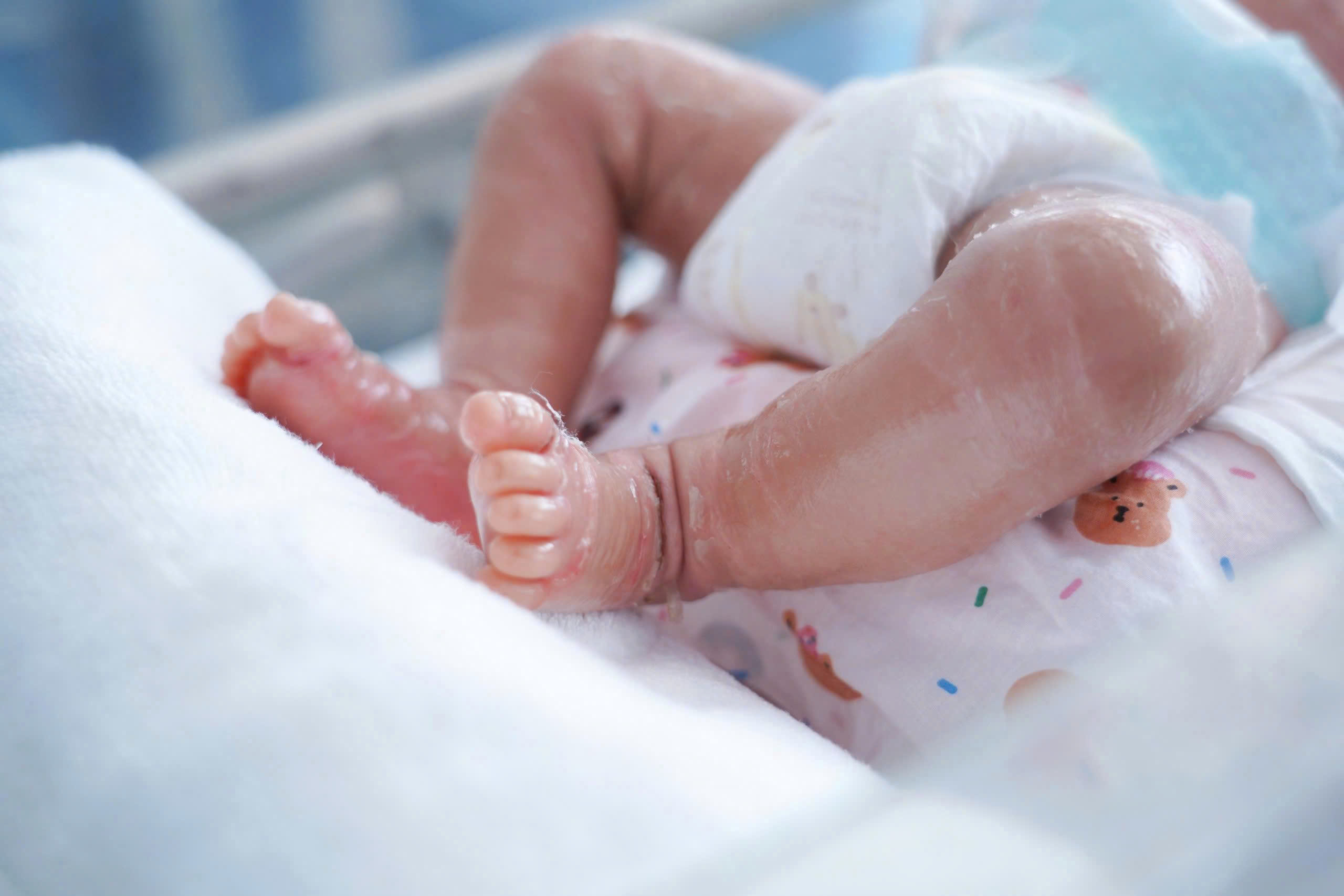 Ngay sau sinh, da của bệnh nhi bị khô, nứt nẻ, căng bóng và được các bác sĩ chẩn đoán bệnh lý vảy cá hiếm gặp - Ảnh: Bệnh viện cung cấp