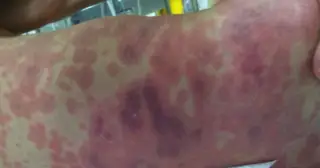 Bệnh não mô cầu, đừng chờ nổi ban mới đi viện