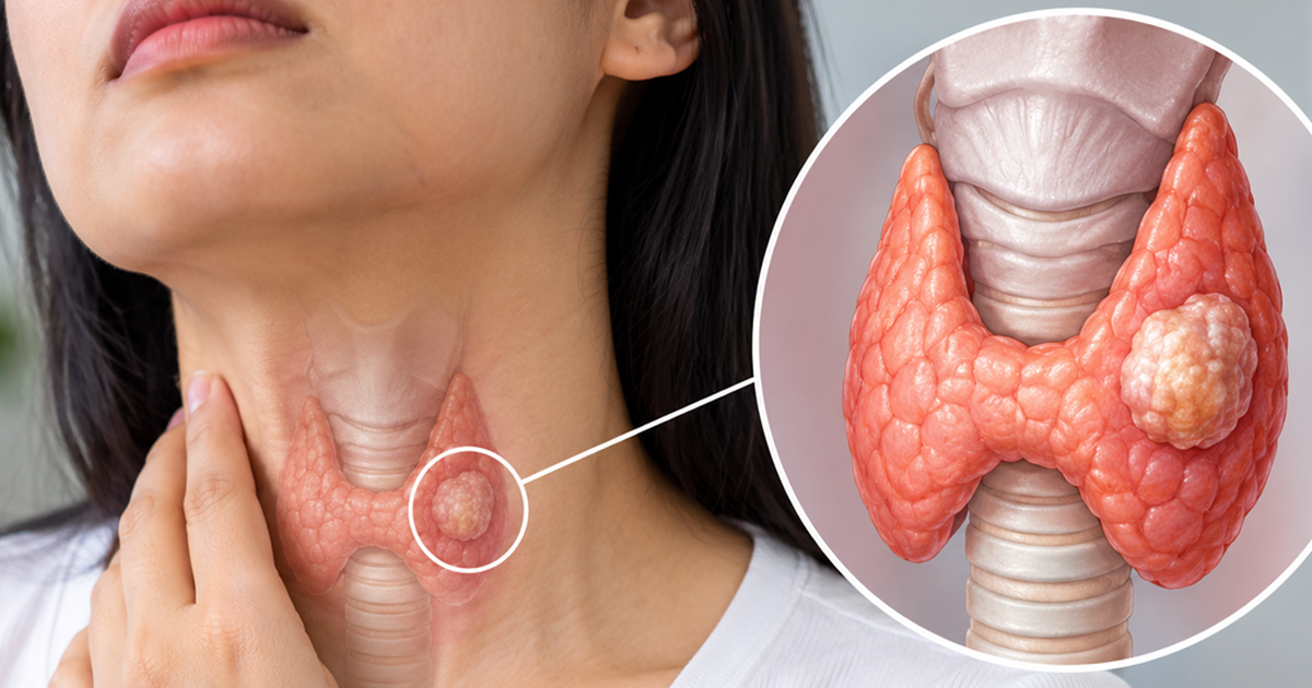 Người trẻ cũng mắc ung thư tuyến giáp: 4 yếu tố nguy cơ cần biết