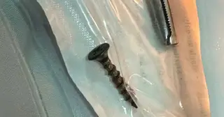 Đinh vít dài 4cm mắc trong đường thở bé gái 3 tháng tuổi