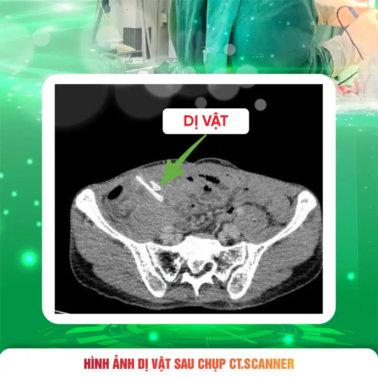Hình ảnh CT và hai mảnh xương sắc nhọn được lấy ra sau phẫu thuật, nguyên nhân khiến người bệnh bị thủng ruột non. ẢNH: B.V
