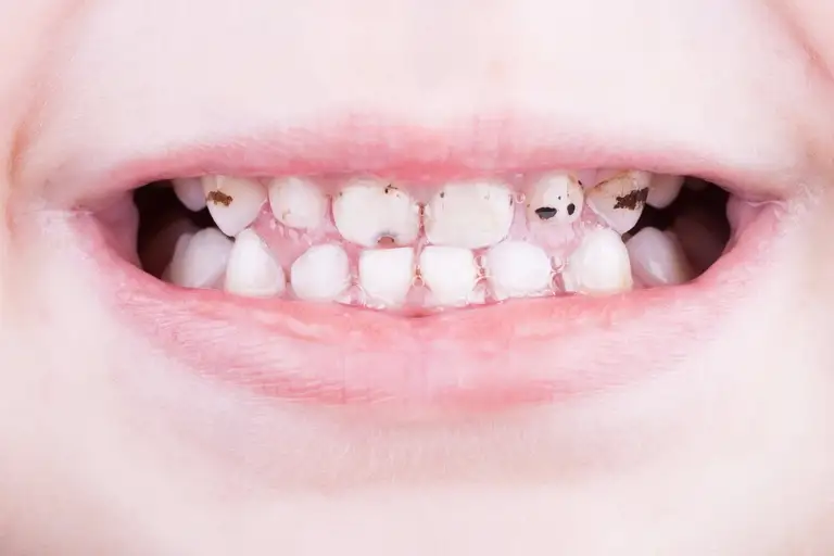 Nhiều trẻ em sợ nha khoa có thể được "hưởng lợi" từ dung dịch bạc diamine fluoride khi điều trị sâu răng - Ảnh: CDM