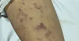 TP.HCM ghi nhận thêm ca mắc não mô cầu ở trẻ 12 tuổi