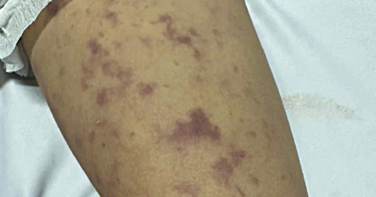 TP.HCM ghi nhận thêm ca mắc não mô cầu ở trẻ 12 tuổi