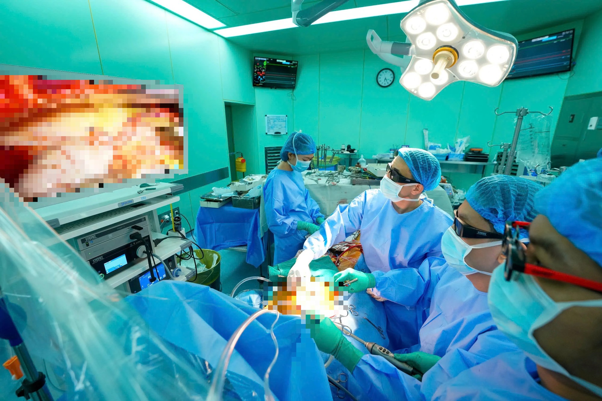 Phẫu thuật viên theo dõi hình ảnh nội soi phóng đại trong quá trình đánh giá và sửa tổn thương van 2 lá