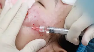 Tiêm botox, filler giả có thể gặp biến chứng gì?