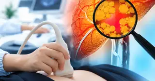 Tập thể thao, ít rượu bia vẫn bị gan nhiễm mỡ vì thói quen tưởng chừng lành mạnh