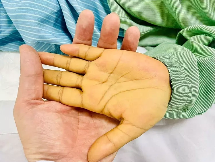 Da một bệnh nhân vàng như nghệ do tải lượng virus viêm gan B trong máu quá cao. Ảnh: Bệnh viện cung cấp