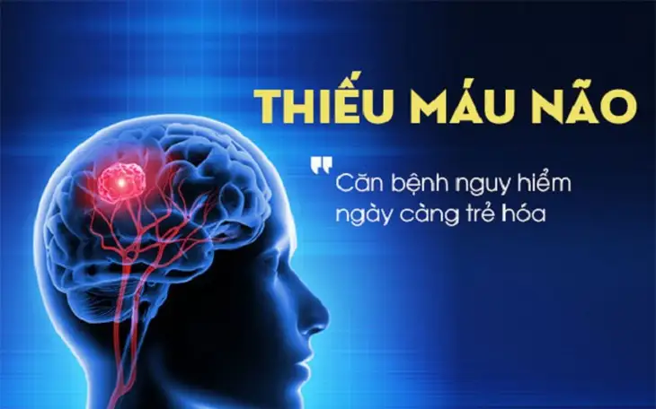Thiếu máu não thoáng qua có thể là dấu hiệu báo trước nguy cơ đột quỵ- Ảnh 1.