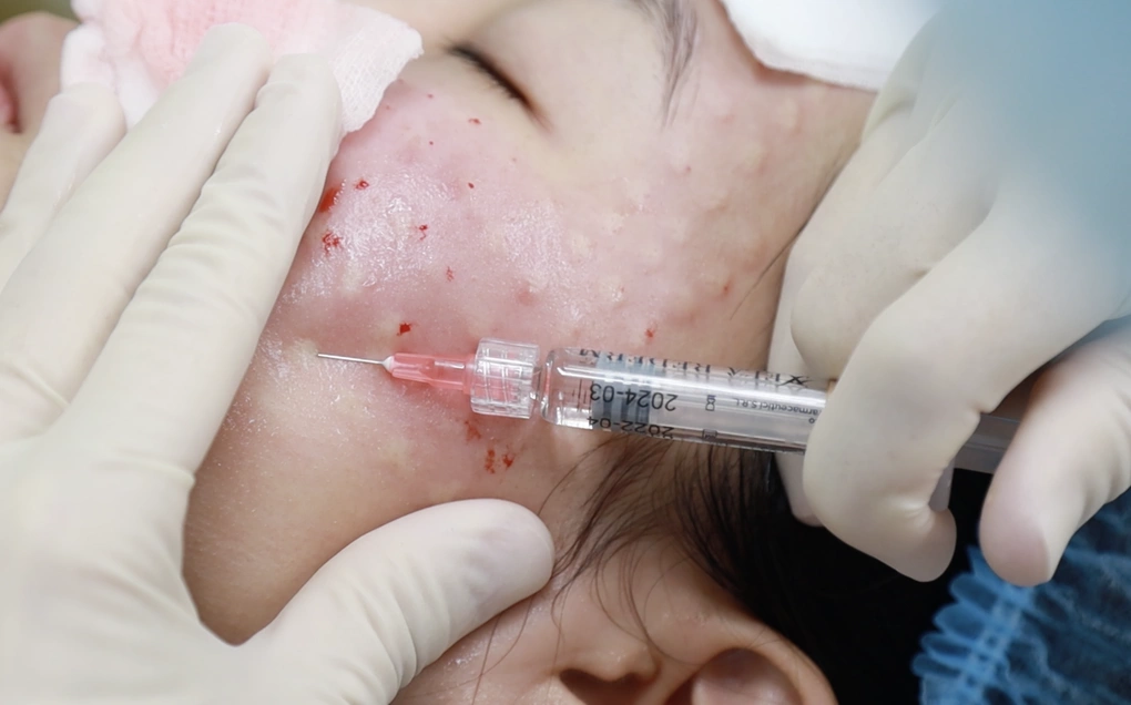 Tiêm botox cho bệnh nhân tại Bệnh viện Da Liễu TP HCM. Ảnh: Bệnh viện cung cấp