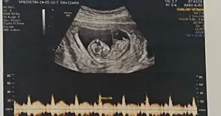 Mất cân bằng giới tính khi sinh: Cần siết việc xử phạt hành vi lựa chọn giới tính
