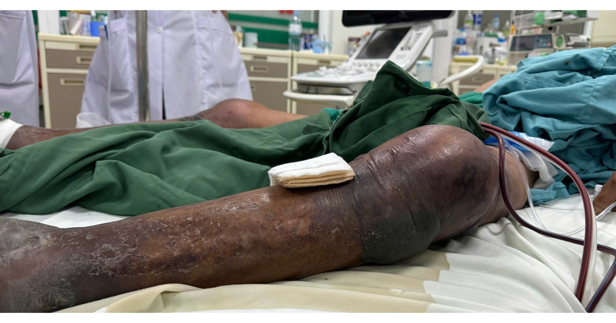 Bị sốc nhiễm khuẩn, suy đa tạng sau ăn tiết canh