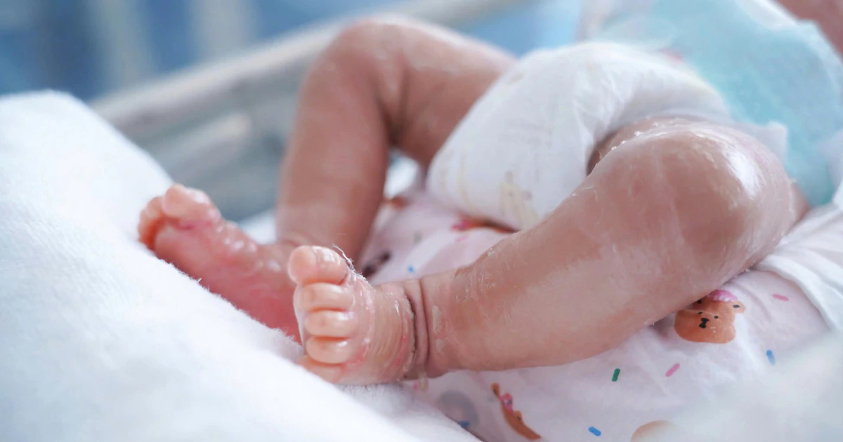 Vừa chào đời, bé trai sơ sinh phát hiện mắc bệnh lý vảy cá hiếm gặp