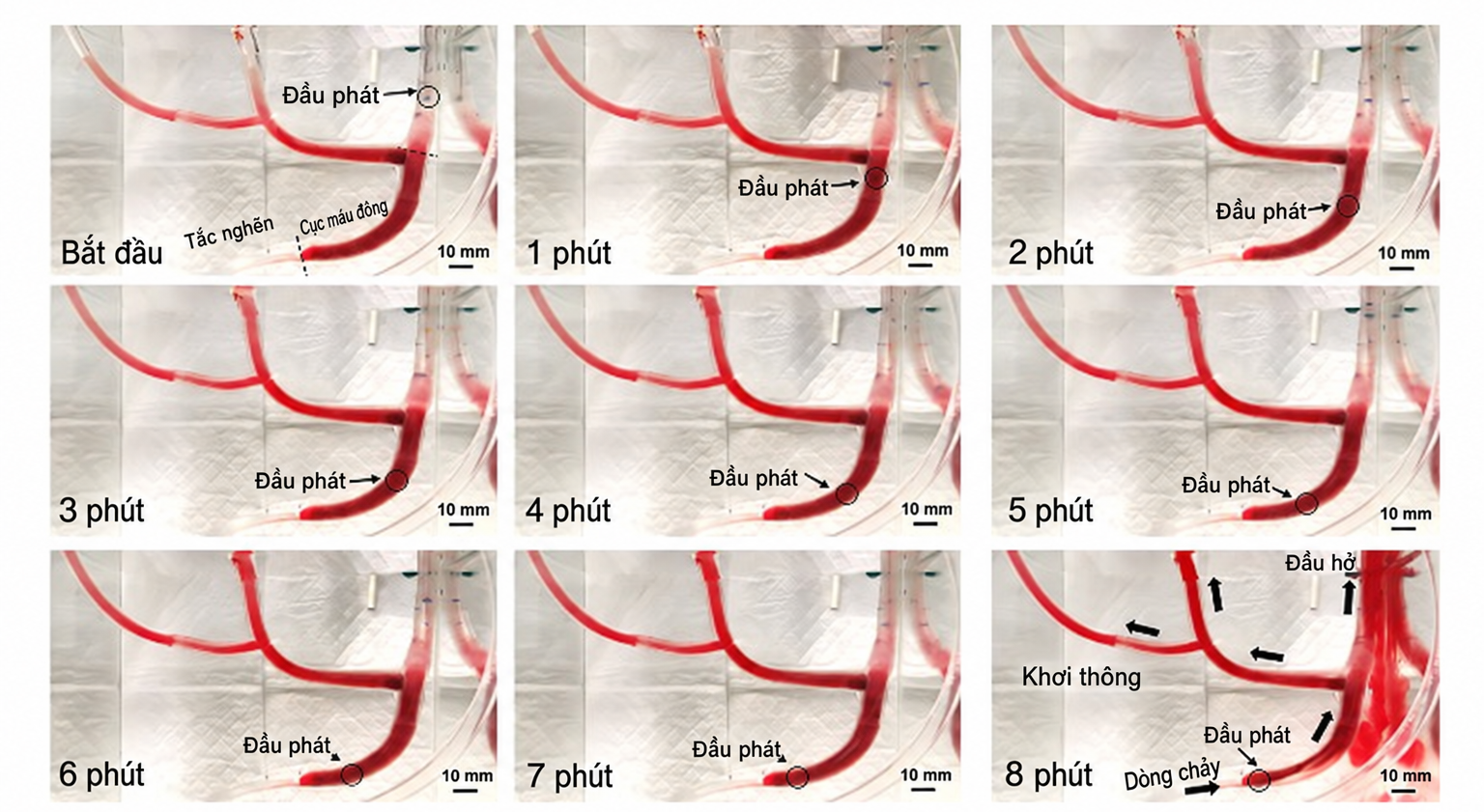 Các bước thử nghiệm dùng siêu âm xoáy khơi thông dòng chảy qua cục máu đông dài gần 8 cm trong mô hình mạch máu sau tám phút - Ảnh: ĐẠI HỌC MICHIGAN