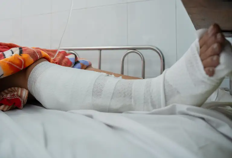Các bác sĩ đã nẹp bột cẳng bàn chân phải bệnh nhân. Ảnh: Bệnh viện cung cấp