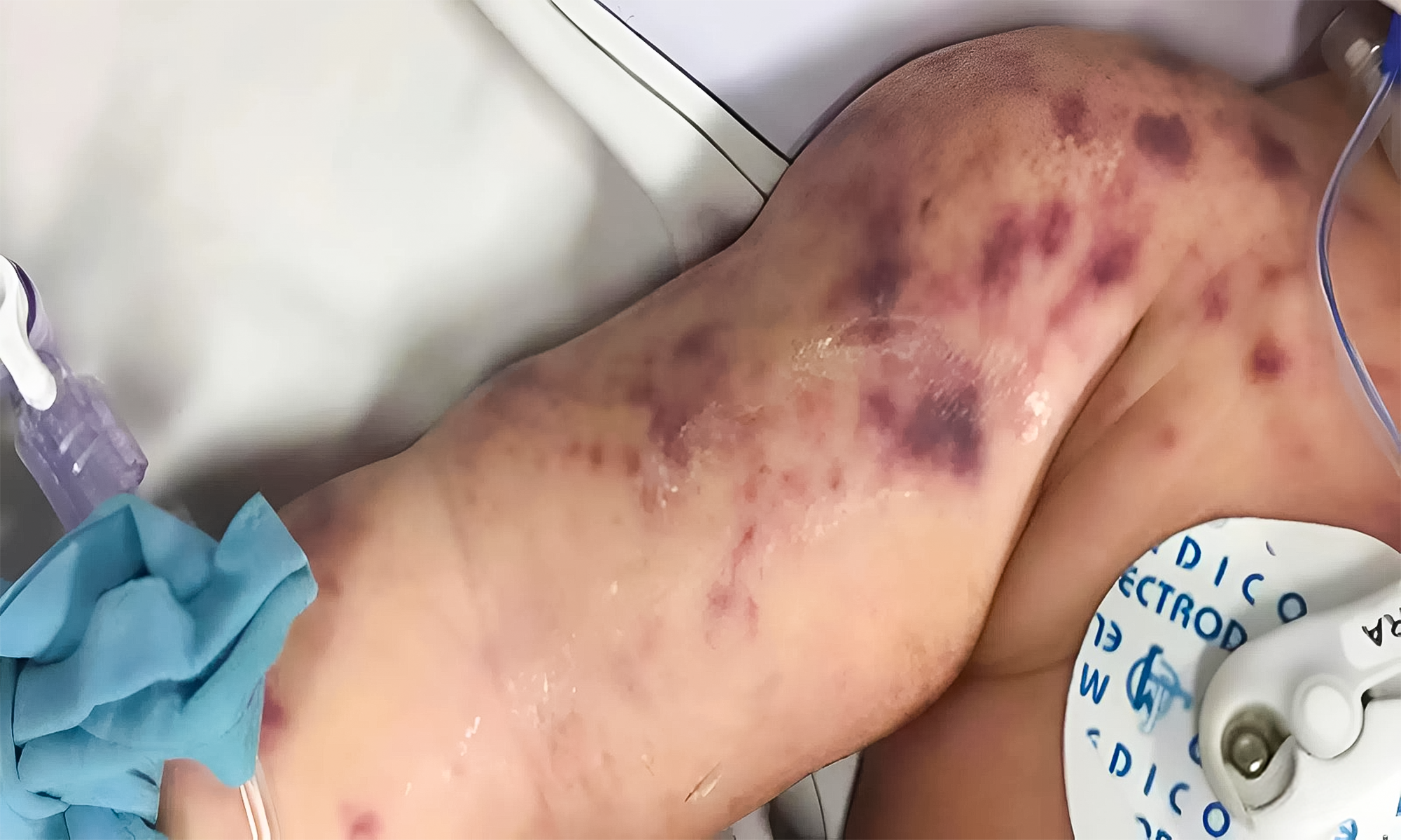 Các nốt ban tím lan rộng trên da của bệnh nhi 8,5 tháng tuổi từng điều trị tại Bệnh viện Nhi đồng 1