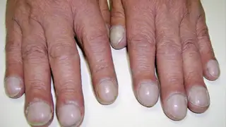 Những dấu hiệu lạ trên móng tay không thể xem thường