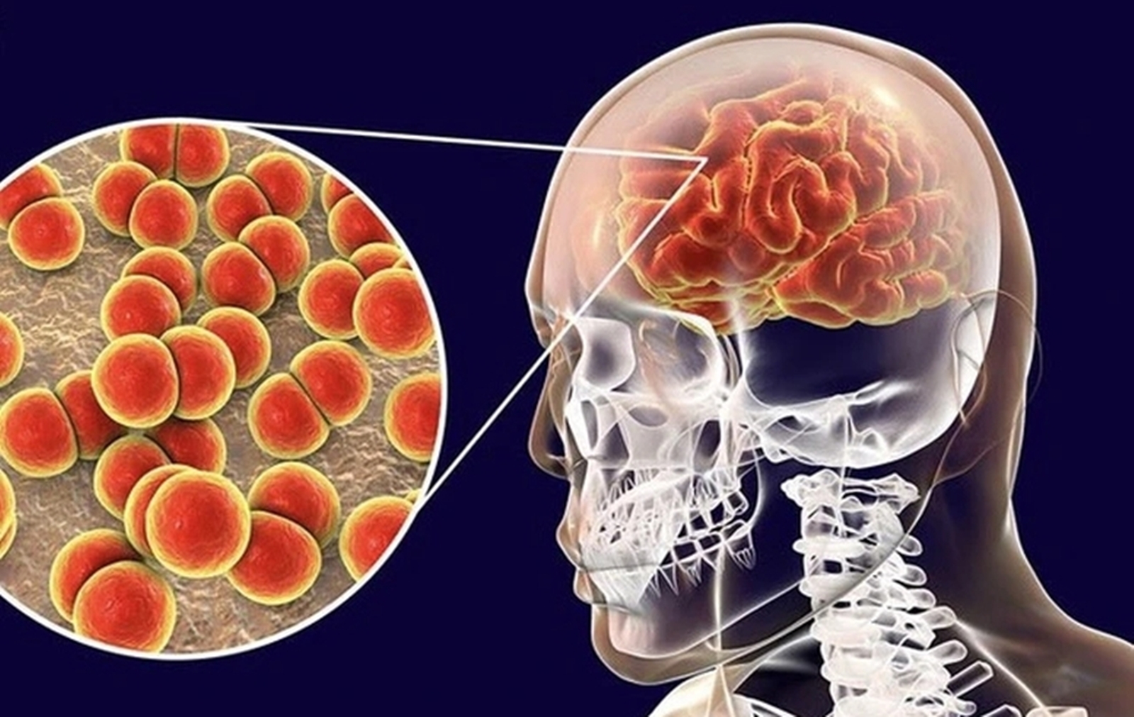 Bệnh não mô cầu diễn tiến nhanh, nguy cơ tử vong nếu không được điều trị kịp thời. Ảnh AI