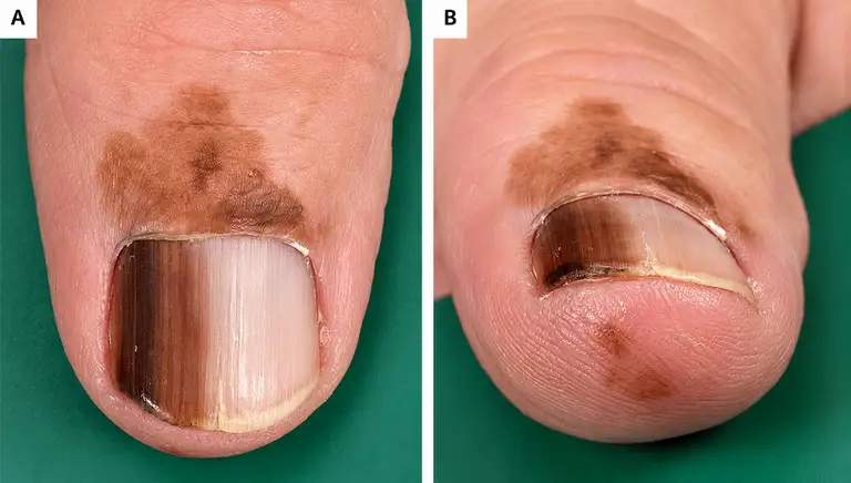 Màu sắc móng tay chân thay đổi có thể cảnh báo bệnh lý